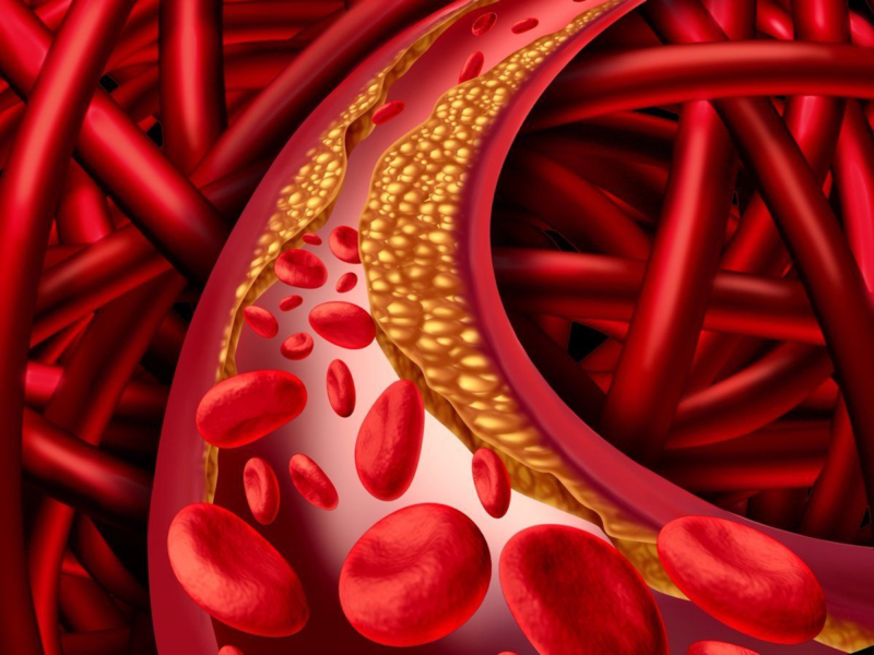 Chỉ số mỡ trong máu cao là yếu tố ảnh hưởng trực tiếp tới sức khỏe con người.