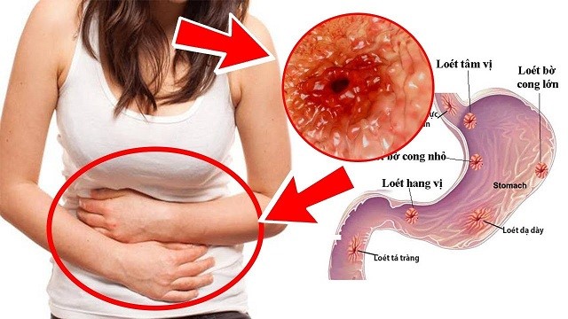 Viêm dạ dày xảy ra khi các vết loét nhiễm khuẩn gây đau bụng